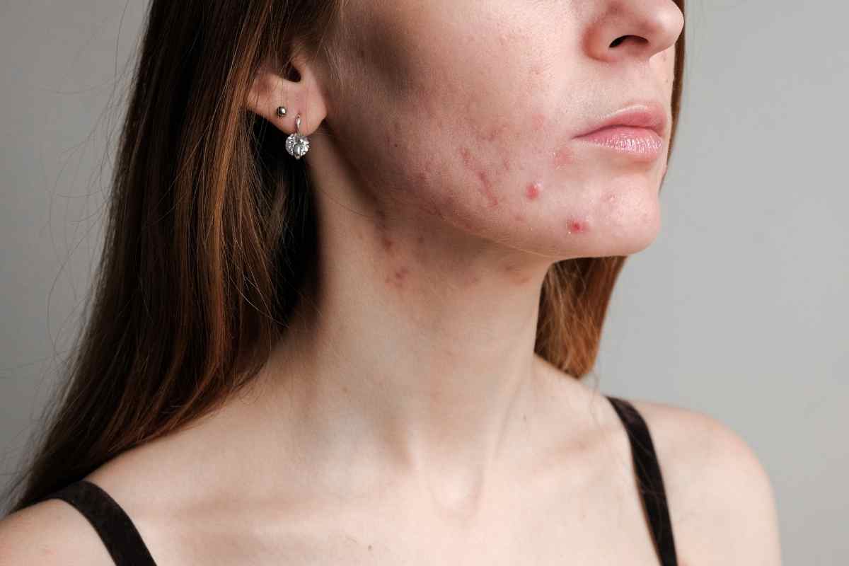 Acne, i rimedi naturali 